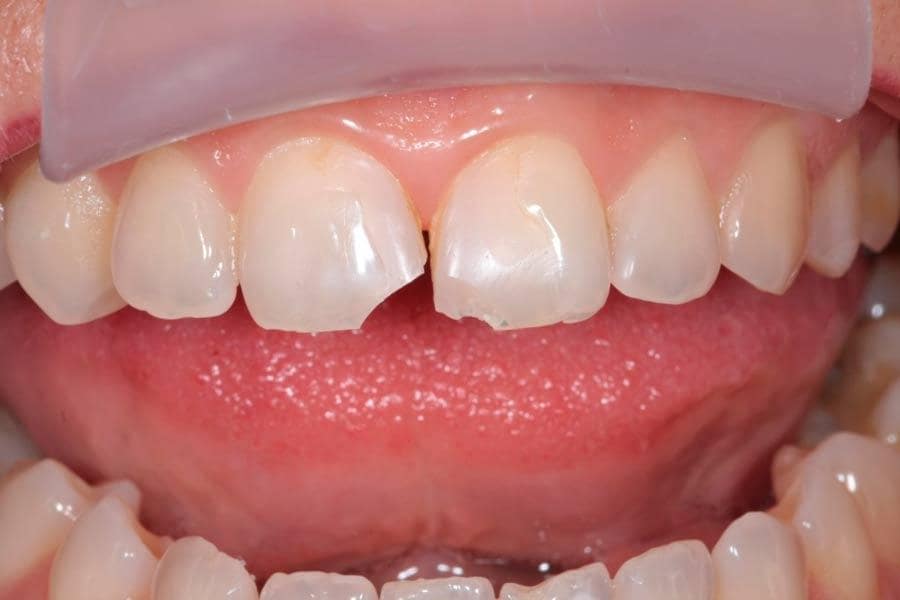 Реставрация переднего зуба в томске красота томск