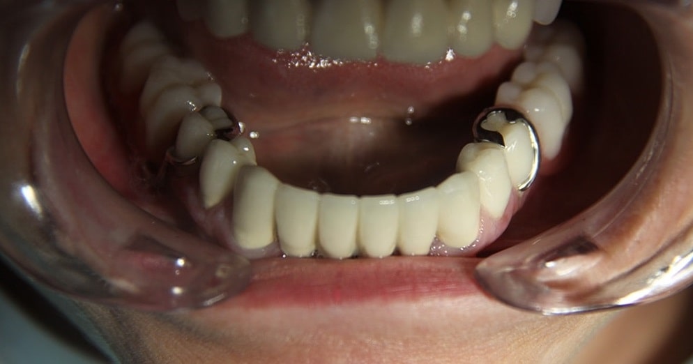 Бюгельный протез Томск Дзержинского стоматология в томске недорого качественно отзывы рядом