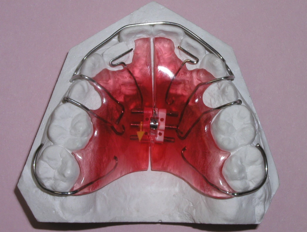 Пластинки для выравнивания зубов Томск Лесозащитная