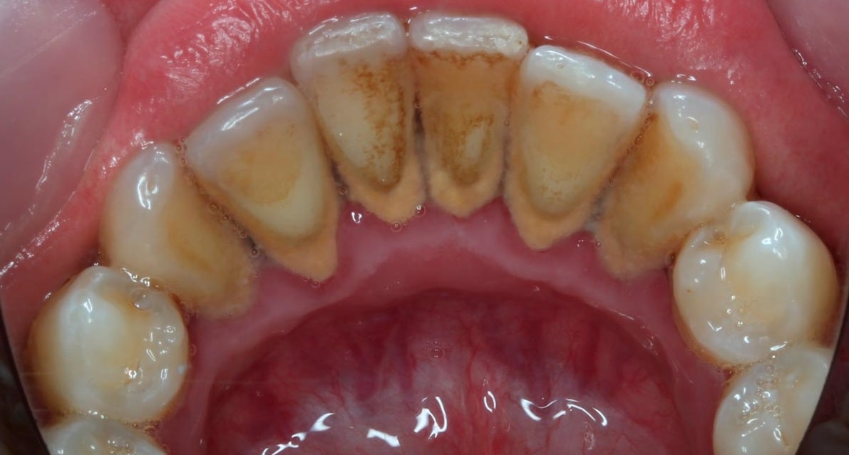 Удаление зуба ультразвуком Томск Дизайнеров стоматология 2 детская томск на мюнниха